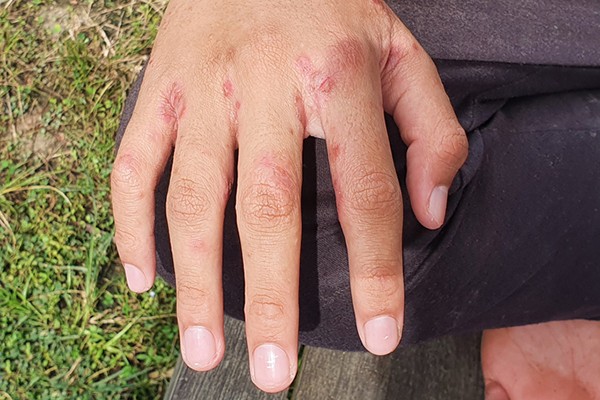 Close-up photograph highlighting scabies, showing inflammation and red marks around the fingers