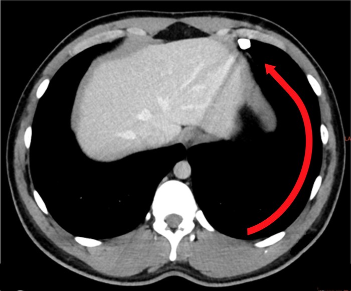 Patient undergoing VATS procedure