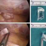 Glass shards found during surgical removal