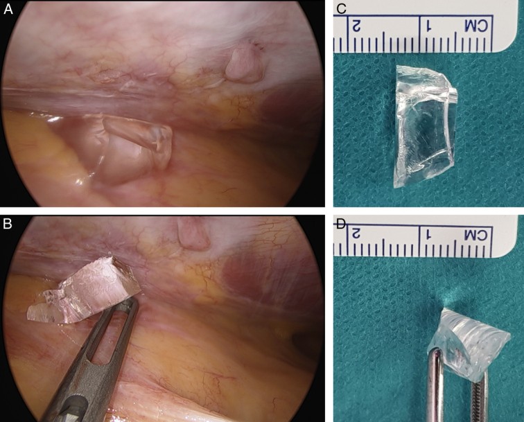 Glass shards found during surgical removal