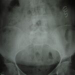X-ray showing a migrated IUD within the abdominal cavity, highlighting the importance of regular check-ups.