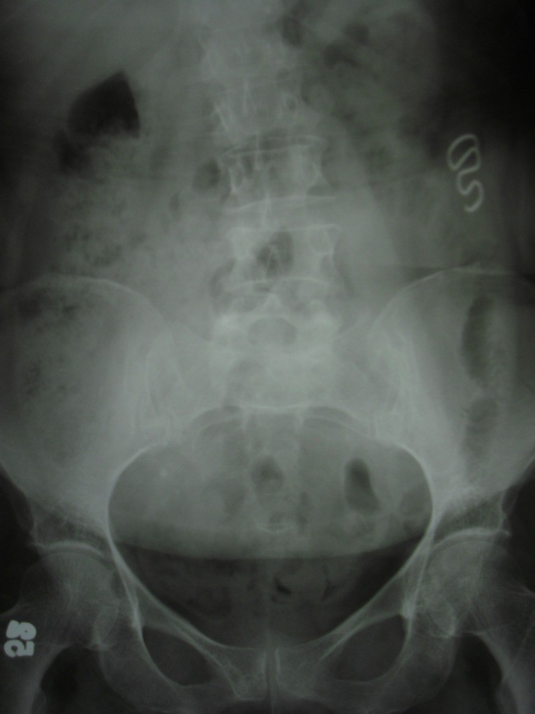 X-ray showing a migrated IUD within the abdominal cavity, highlighting the importance of regular check-ups.