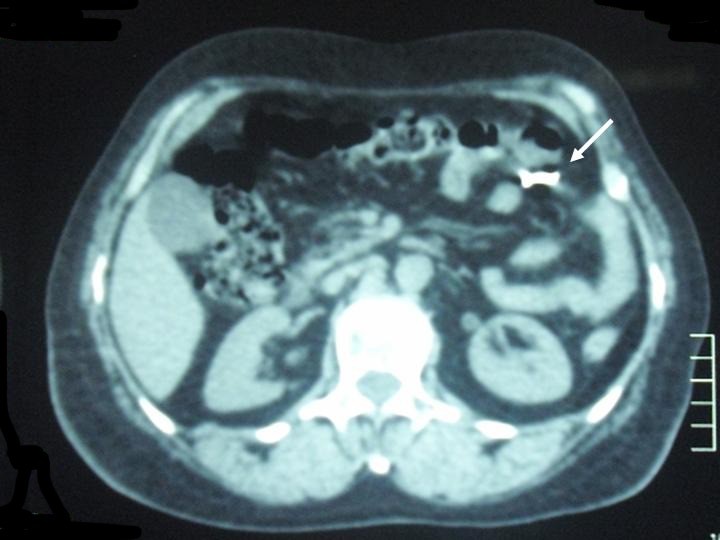CT scan showing the location of a migrated IUD outside the uterus, aiding in diagnosis and treatment planning.