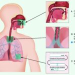 Coughing mechanisms